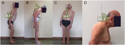 Does the Degree of Trunk Bending Predict Patient Disability, Motor Impairment, Falls, and Back Pain in Parkinson's Disease?